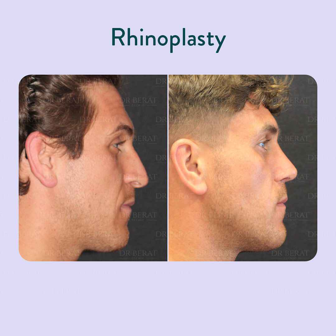 Rhinoplasty Antalya Turkey rhinoplasty-antalya-turkey