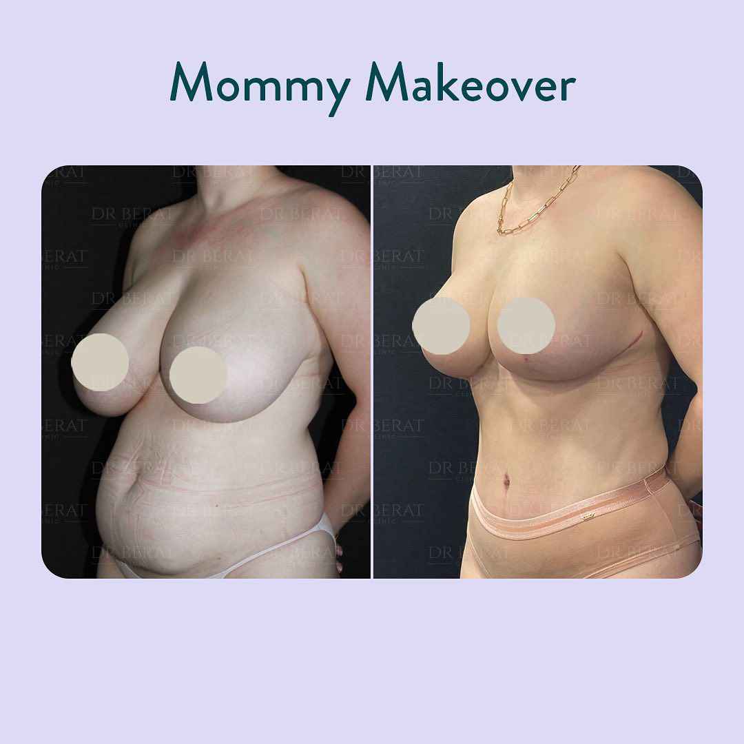 Mommy Makeover in Turkey-Antalya