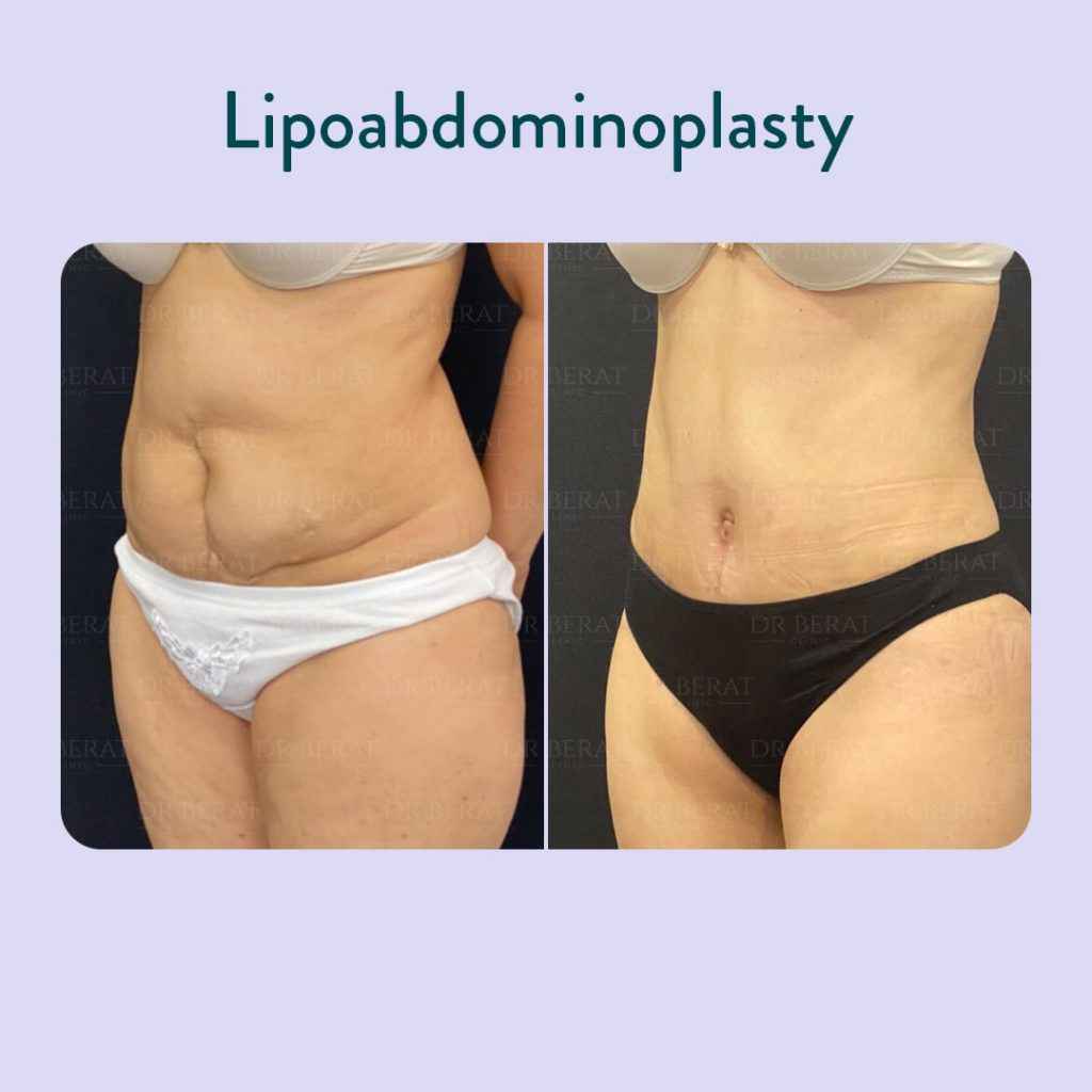 Lipoabdominoplasti in Turkey