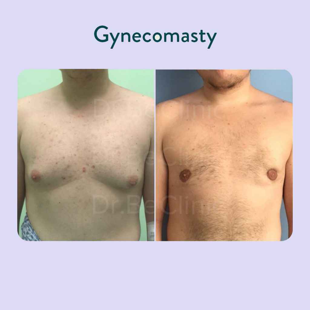 Gynecomastia in Turkey