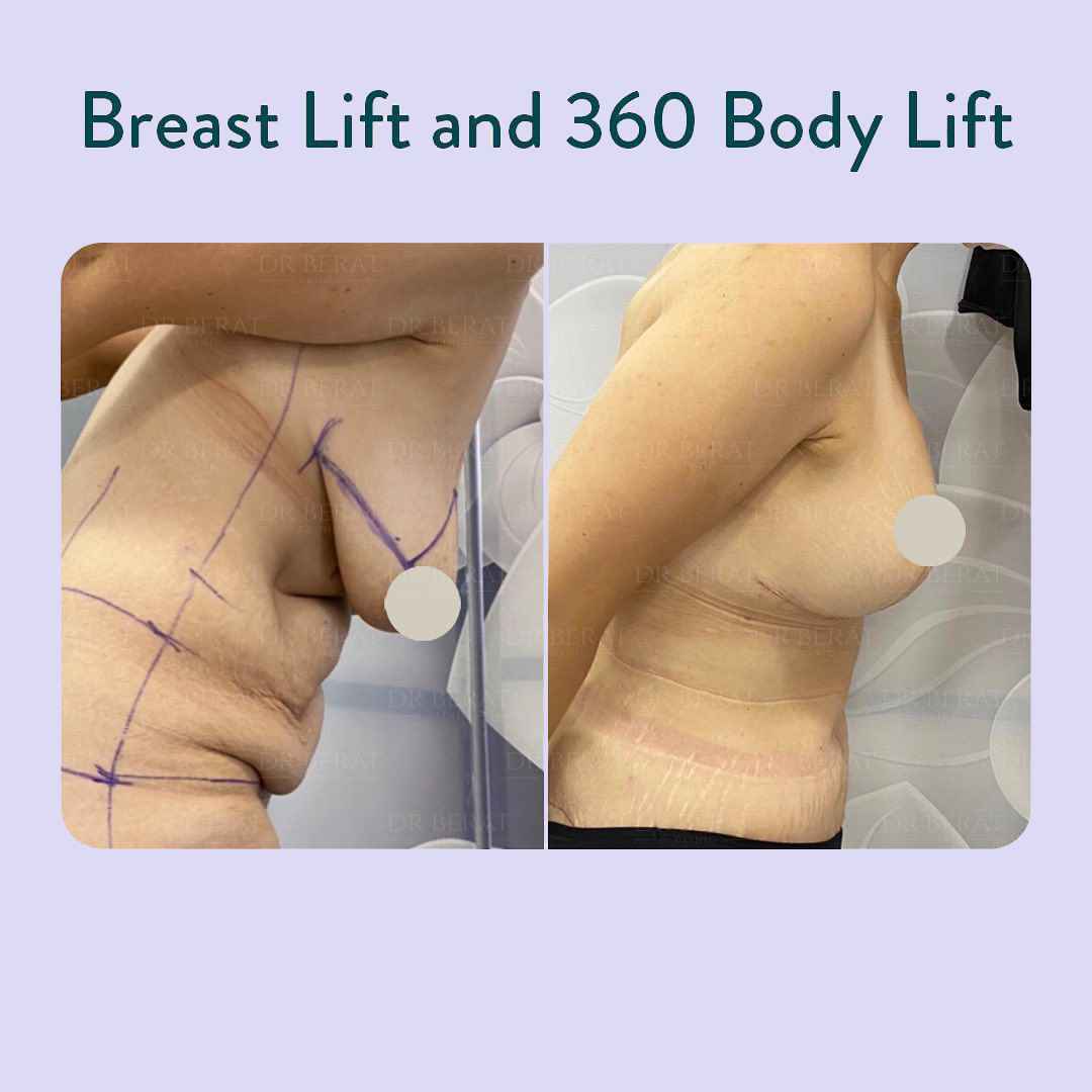 Breast Lift and 360 body lift