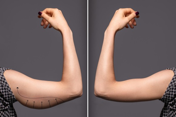 Arm lift-Arm aesthetic-Antalya Arm lift-Arm aesthetic-Antalya