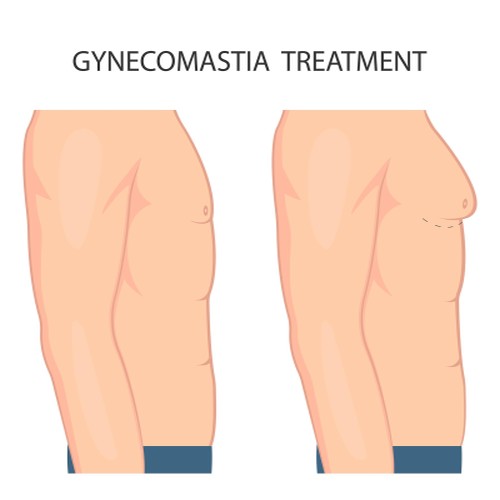 Gynecomastia Gynecomastia surgery-Gynecomastia surgery cost Antalya