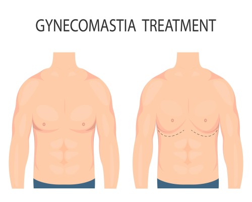 Gynecomastia-Man boobs surgery in Turkey Gynecomastia-Man boobs surgery in Turkey