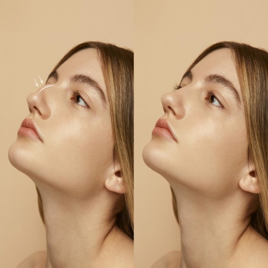 Rhinoplasty-Nose job Rhinoplasty-Nose job-Nose surgery
